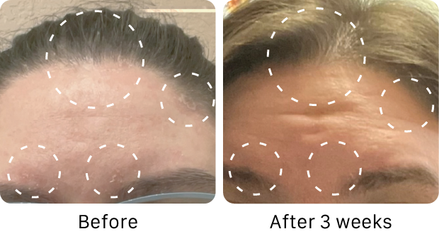 ACTIIV Remedy Scalp Treatment